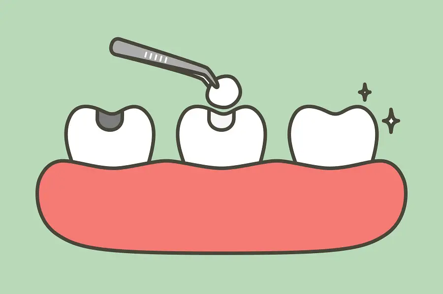 All About Amalgam, Why We Only Offer Mercury-Free Fillings